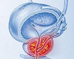 Upala prostate s prostatitisom