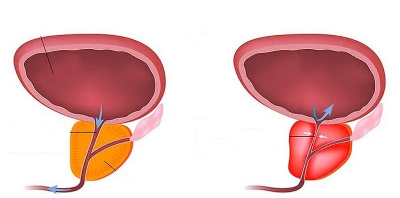 Zdrava i upaljena prostata prostatitisom