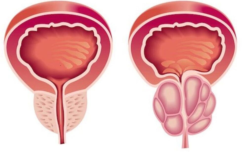 zdrava i upaljena prostata s prostatitisom