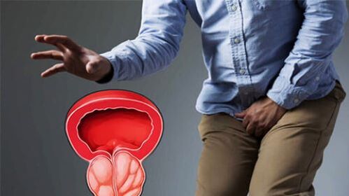 simptomi prostatitisa kod muškarca
